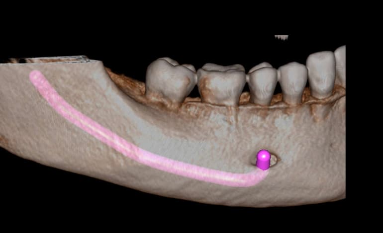 Tomografia Computadorizada (3D Cone Beam)