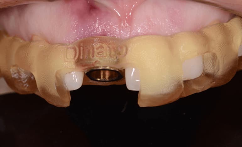 Cirurgia Guiada e prototipagem