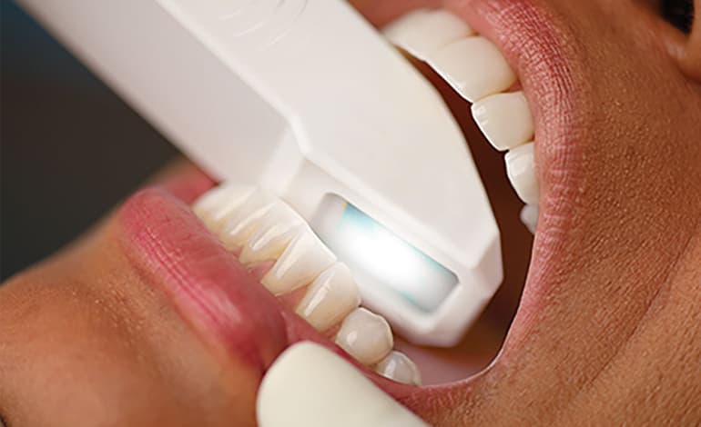 Escaneamento Intraoral e Extraoral